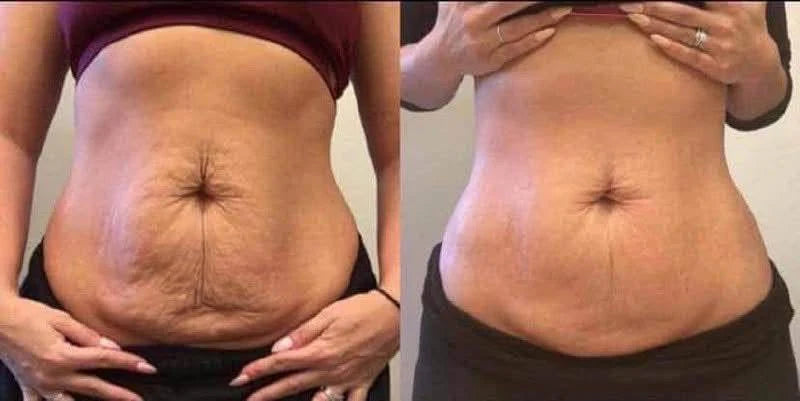 Piel más firme y lisa, incluso después de cambios fuertes en tu cuerpo
