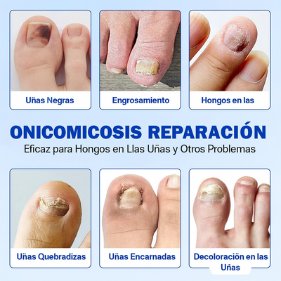 Fungal Nail Patches | ¿Uñas con Hongos? Este Parche Elimina la Infección en Días