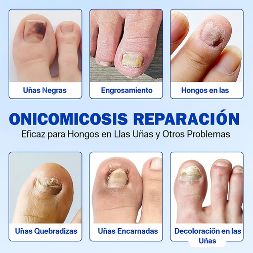 Fungal Nail Patches | ¿Uñas con Hongos? Este Parche Elimina la Infección en Días