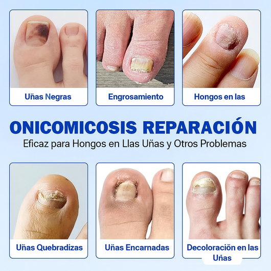Fungal Nail Patches | ¿Uñas con Hongos? Este Parche Elimina la Infección en Días